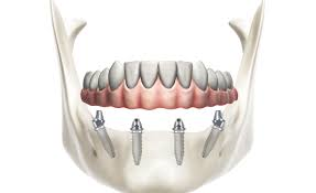 ALL ON FOUR PROTESI FISSA DAI 10 AI 12 ELEMENTI CON 4 IMPIANTI A SOLO 5900 EURO – Studio Dental Smile