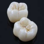 Home – ELEMENTO IN METALLO CERAMICA 333 EURO – Studio Dental Smile